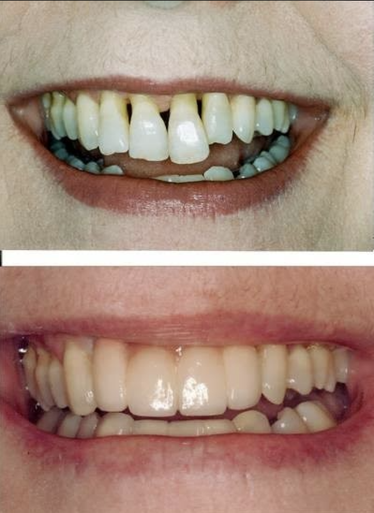 Before and after dental implant treatment