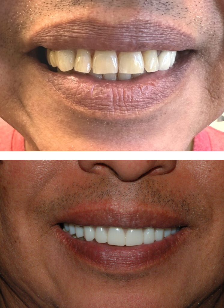 Before and after laser gum treatment