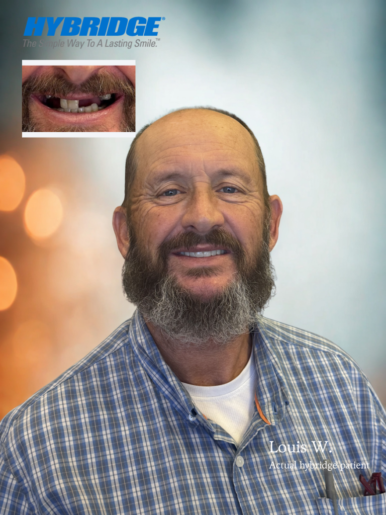 Hybridge full-arch dental implant photo 1